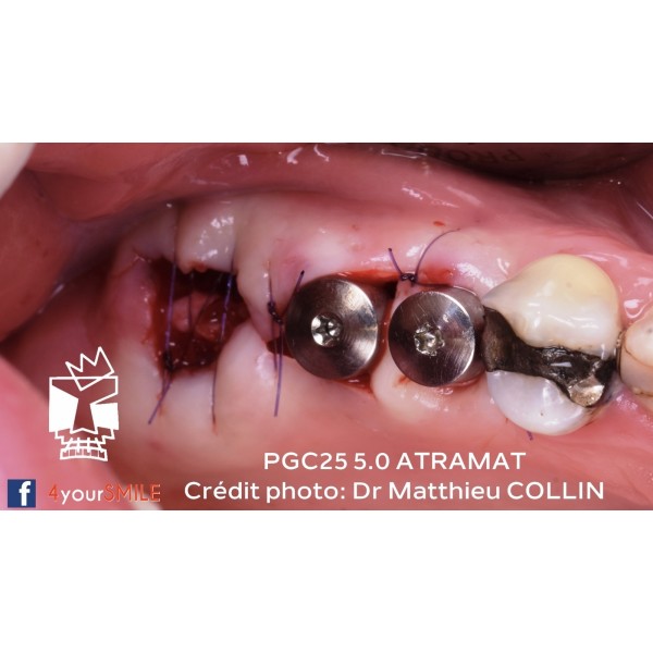 43.90€ - Boîte de 12 Sutures PGC25 - Résorbable Monofilament