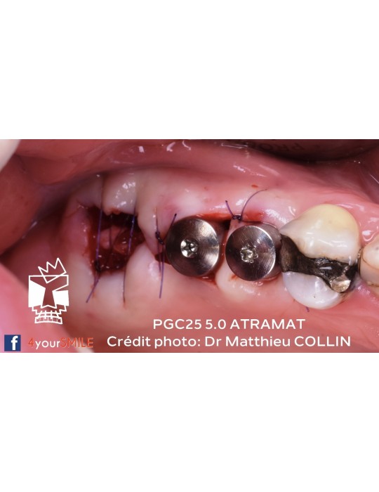 43.90€ - Boîte de 12 Sutures PGC25 - Résorbable Monofilament