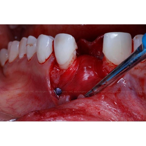 Pins Titane - MC Bio Surgery