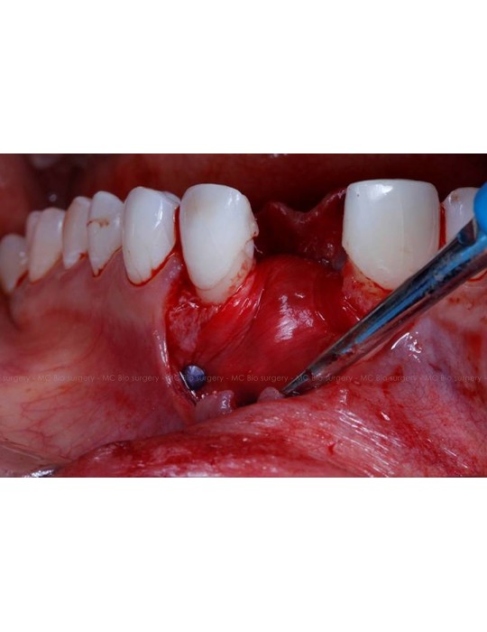 Pins Titane - MC Bio Surgery