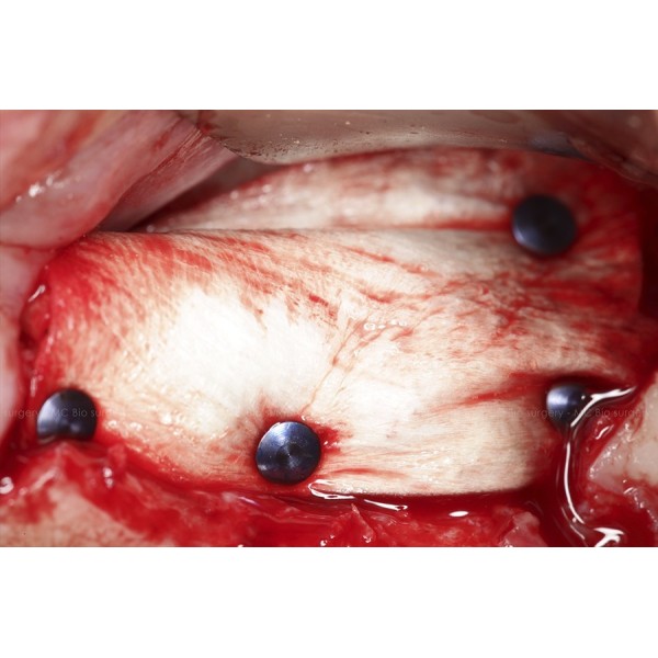 Pins Titane - MC Bio Surgery