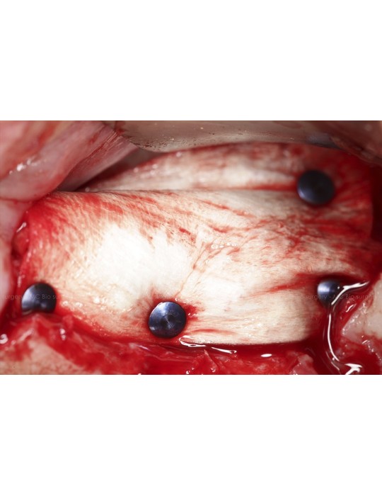 Pins Titane - MC Bio Surgery