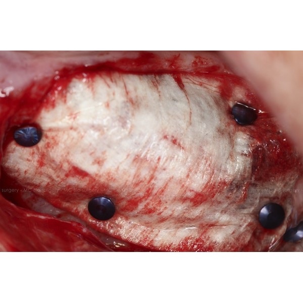 Pins Titane - MC Bio Surgery