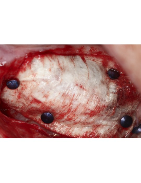 Pins Titane - MC Bio Surgery