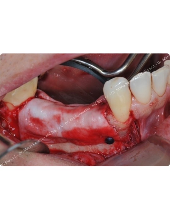 Pins Titane - MC Bio Surgery