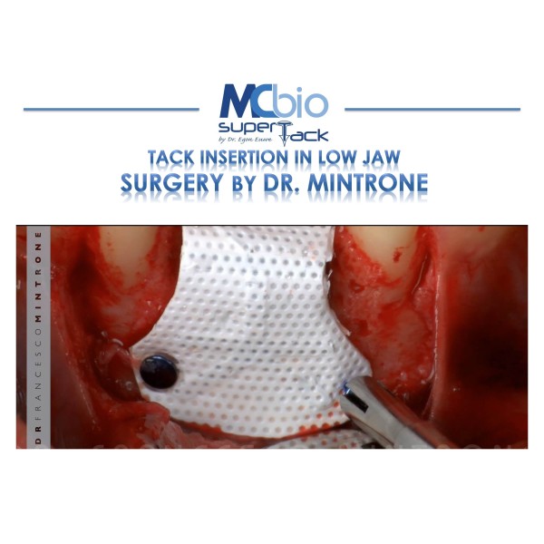 Applicateur Pins Super Tack et accessoires- MC bio Surgery