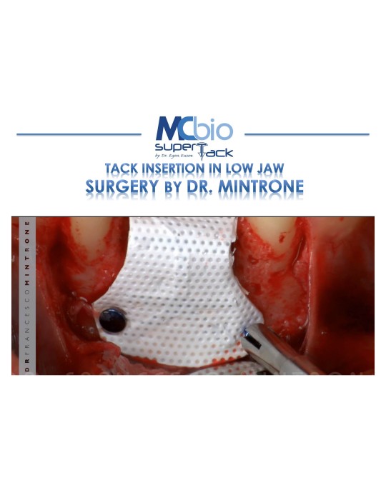 Applicateur Pins Super Tack et accessoires- MC bio Surgery