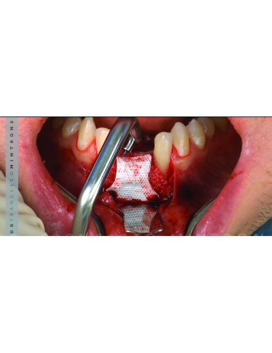 Applicateur Lingual - MC bio Surgery