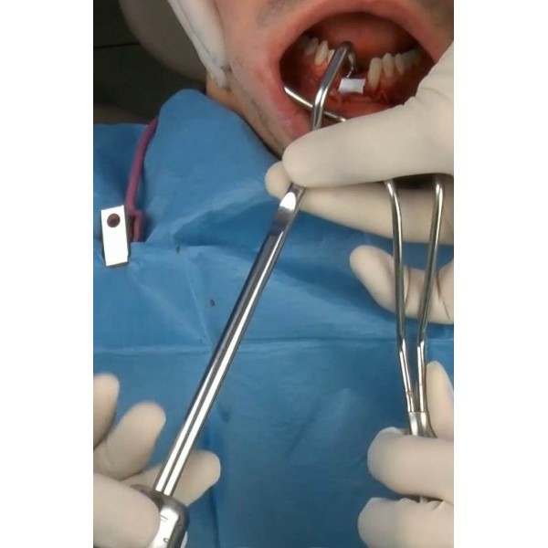 Applicateur Lingual - MC bio Surgery