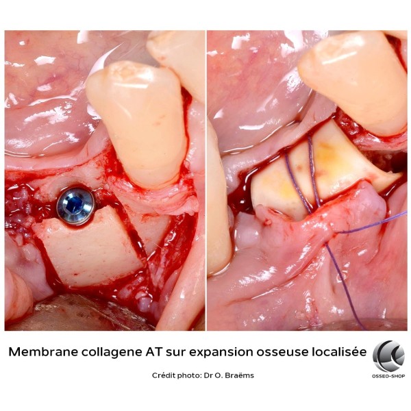 Membrane collagène AT - Boîte de 6 - 295€ TTC