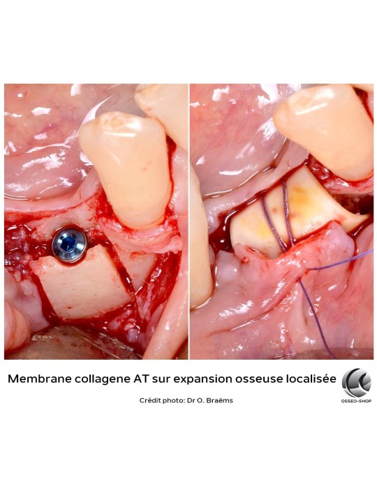 Membrane collagène AT - Boîte de 6 - 295€ TTC