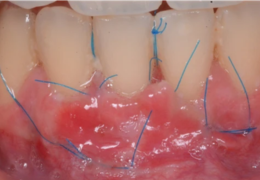 Fils de suture en chirurgie dentaire : comment optimiser vos choix cliniques ?